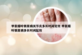 甲氨蝶呤银屑病关节炎多长时间见效 甲氨蝶呤银屑病多长时间起效
