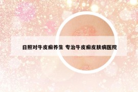 日照对牛皮癣养生 专治牛皮癣皮肤病医院