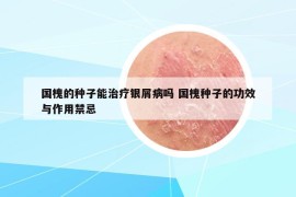 国槐的种子能治疗银屑病吗 国槐种子的功效与作用禁忌