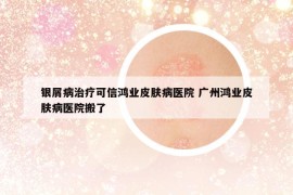 银屑病治疗可信鸿业皮肤病医院 广州鸿业皮肤病医院搬了
