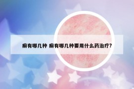癣有哪几种 癣有哪几种要用什么药治疗?