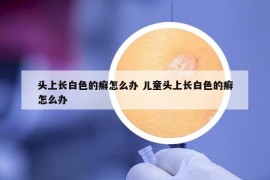 头上长白色的癣怎么办 儿童头上长白色的癣怎么办