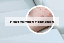 广州看牛皮癣权威医院 广州看银屑病医院