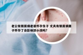老公有银屑病老婆怀孕生子 丈夫有银屑病妻子怀孕了会影响到小孩吗?