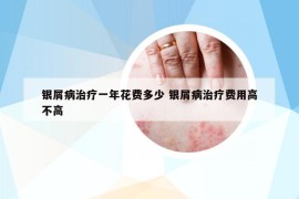 银屑病治疗一年花费多少 银屑病治疗费用高不高