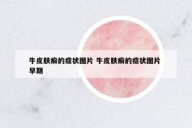 牛皮肤癣的症状图片 牛皮肤癣的症状图片 早期