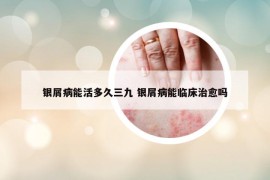 银屑病能活多久三九 银屑病能临床治愈吗