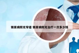 银屑病照光窄谱 银屑病照光治疗一次多少钱