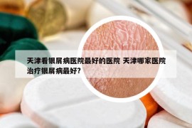 天津看银屑病医院最好的医院 天津哪家医院治疗银屑病最好?