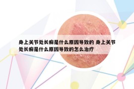 身上关节处长癣是什么原因导致的 身上关节处长癣是什么原因导致的怎么治疗