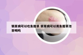 银屑病可以吃鱼腥草 银屑病可以用鱼腥草泡茶喝吗