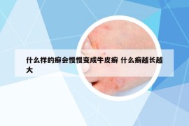 什么样的癣会慢慢变成牛皮癣 什么癣越长越大