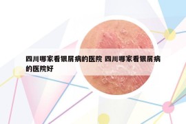 四川哪家看银屑病的医院 四川哪家看银屑病的医院好