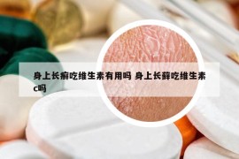 身上长癣吃维生素有用吗 身上长藓吃维生素c吗