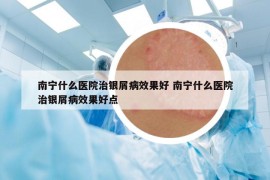 南宁什么医院治银屑病效果好 南宁什么医院治银屑病效果好点