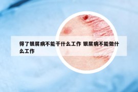 得了银屑病不能干什么工作 银屑病不能做什么工作