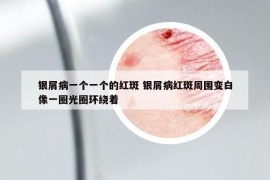 银屑病一个一个的红斑 银屑病红斑周围变白像一圈光圈环绕着