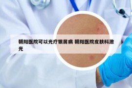朝阳医院可以光疗银屑病 朝阳医院皮肤科激光