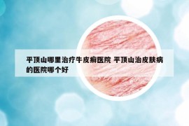 平顶山哪里治疗牛皮癣医院 平顶山治皮肤病的医院哪个好