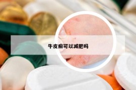 牛皮癣可以减肥吗