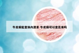 牛皮癣能查体内激素 牛皮癣可以查出来吗