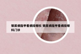 银屑病指甲看病挂哪科 银屑病指甲看病挂哪科门诊