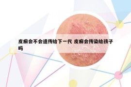 皮癣会不会遗传给下一代 皮癣会传染给孩子吗