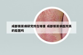 成都银屑病研究院在哪里 成都银屑病医院真的能医吗