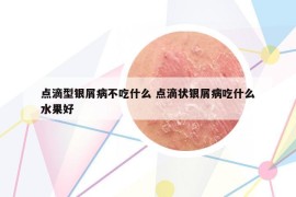 点滴型银屑病不吃什么 点滴状银屑病吃什么水果好