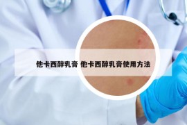 他卡西醇乳膏 他卡西醇乳膏使用方法