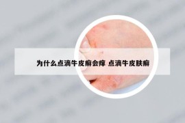 为什么点滴牛皮癣会痒 点滴牛皮肤癣