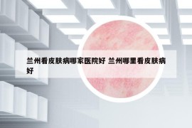 兰州看皮肤病哪家医院好 兰州哪里看皮肤病好