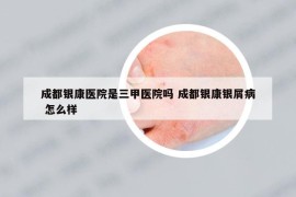 成都银康医院是三甲医院吗 成都银康银屑病 怎么样