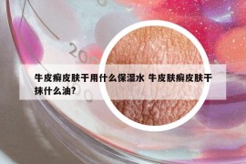 牛皮癣皮肤干用什么保湿水 牛皮肤癣皮肤干抹什么油?
