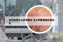 治疗藓用什么药膏最好 怎么判断是癣还是皮炎