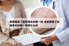 皮肤痒抓了后就像长的癣一样 皮肤痒抓了后就像长的癣一样擦什么药