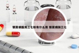 银屑病服用三七粉有什么用 银屑病抹三七