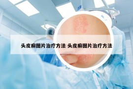 头皮癣图片治疗方法 头皮癣图片治疗方法