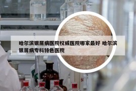哈尔滨银屑病医院权威医院哪家最好 哈尔滨银屑病专科特色医院