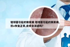 链球菌引起的银屑病 链球菌引起的银屑病,抗o恢复正常,皮疹会消退吗?