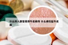 什么样人群容易得牛皮癣传 什么病引起牛皮癣