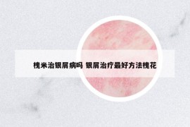 槐米治银屑病吗 银屑治疗最好方法槐花