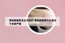 掌趾脓疱疹怎么引起的 掌趾脓疱疹什么情况下会更严重