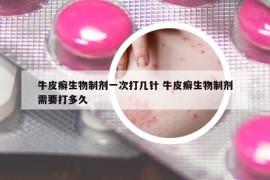 牛皮癣生物制剂一次打几针 牛皮癣生物制剂需要打多久