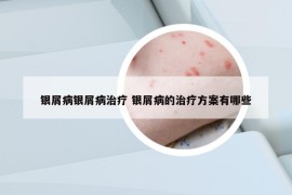 银屑病银屑病治疗 银屑病的治疗方案有哪些