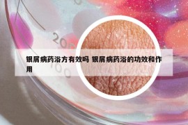 银屑病药浴方有效吗 银屑病药浴的功效和作用