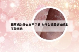 银屑病为什么当不了兵 为什么银屑病被规定不能当兵