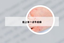 脸上有一点牛皮癣
