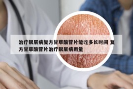 治疗银屑病复方甘草酸苷片能吃多长时间 复方甘草酸苷片治疗银屑病用量