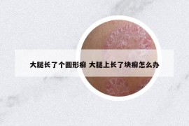 大腿长了个圆形癣 大腿上长了块癣怎么办